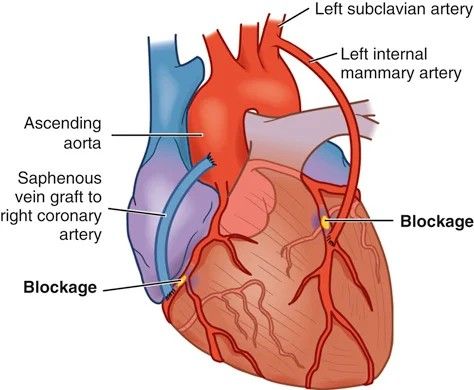 CABG. The left internal mammary artery is redirected past the blockage; a saphenous vein graft bypasses a second lesion on the right coronary artery.