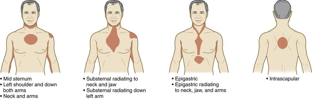 Pain patterns in angina and MI: mid-sternum; substernal radiating to neck and jaw or down the left arm; epigastric, which may radiate to neck, jaw, and arms; and interscapular.