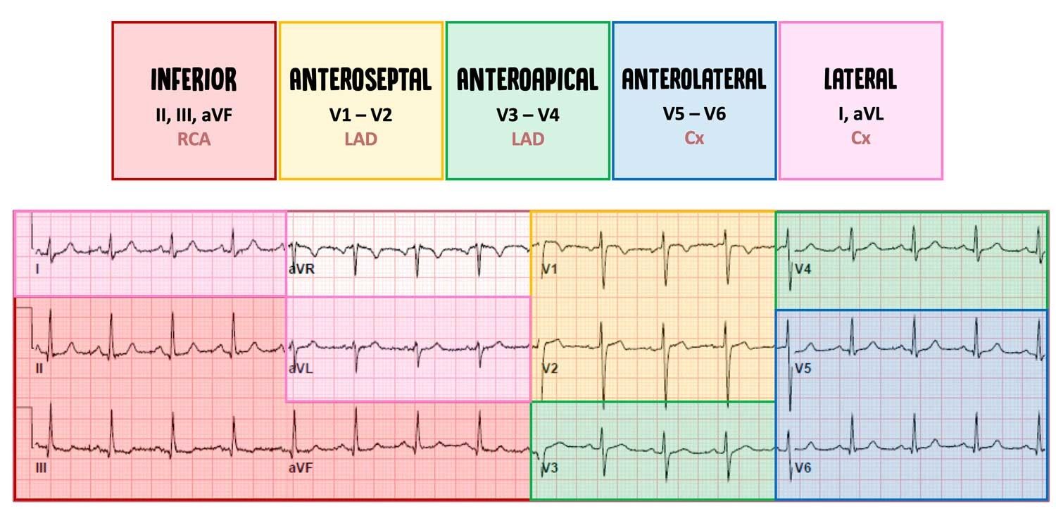 Lead groups color-coded to their walls and arteries: inferior (II, III, aVF) = RCA; anteroseptal (V1–V2) and anteroapical (V3–V4) = LAD; anterolateral (V5–V6) and lateral (I, aVL) = circumflex.