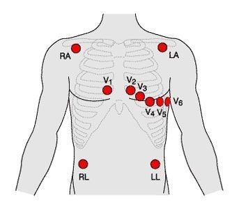Twelve-lead placement. V1 and V2 flank the sternum at the fourth intercostal space; V3 through V6 progress laterally.