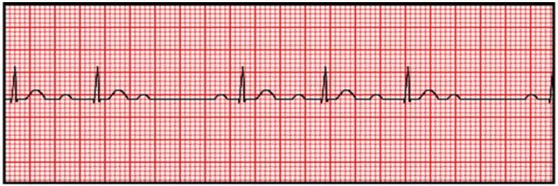 Mobitz I. The PR interval stretches beat by beat until a QRS is dropped, then the cycle restarts.