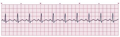 Normal sinus rhythm.