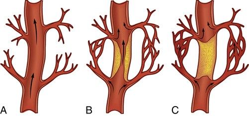 Collateral circulation developing around a plaque. In A no collaterals exist; in B and C anastomoses have formed and enlarged, carrying flow past the obstruction.