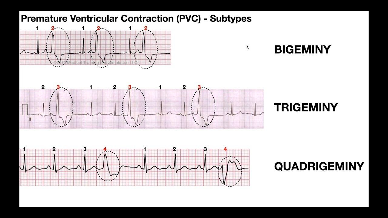 PVC patterns: bigeminy (every second beat), trigeminy (every third), and quadrigeminy (every fourth).