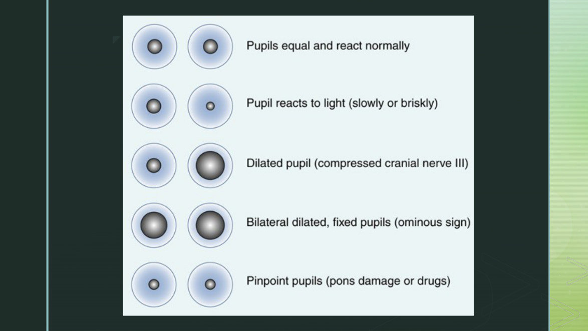 Her pupil findings slide. Read it as a progression rather than a menu: equal and briskly reactive → sluggish on one side (early pressure on CN III) → one pupil dilated and fixed (herniation) → both dilated and fixed.