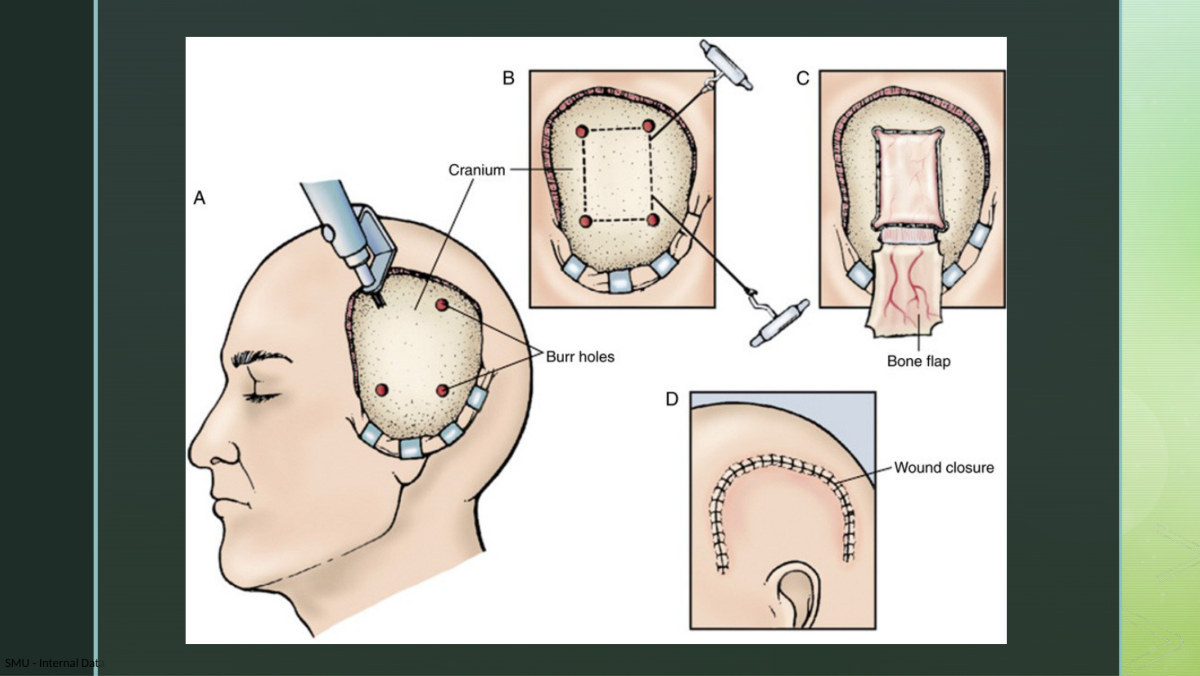 Her cranial surgery slide comparing craniectomy, craniotomy and cranioplasty. The whole distinction is in the third column of the table above: does the bone go back on today, or not?