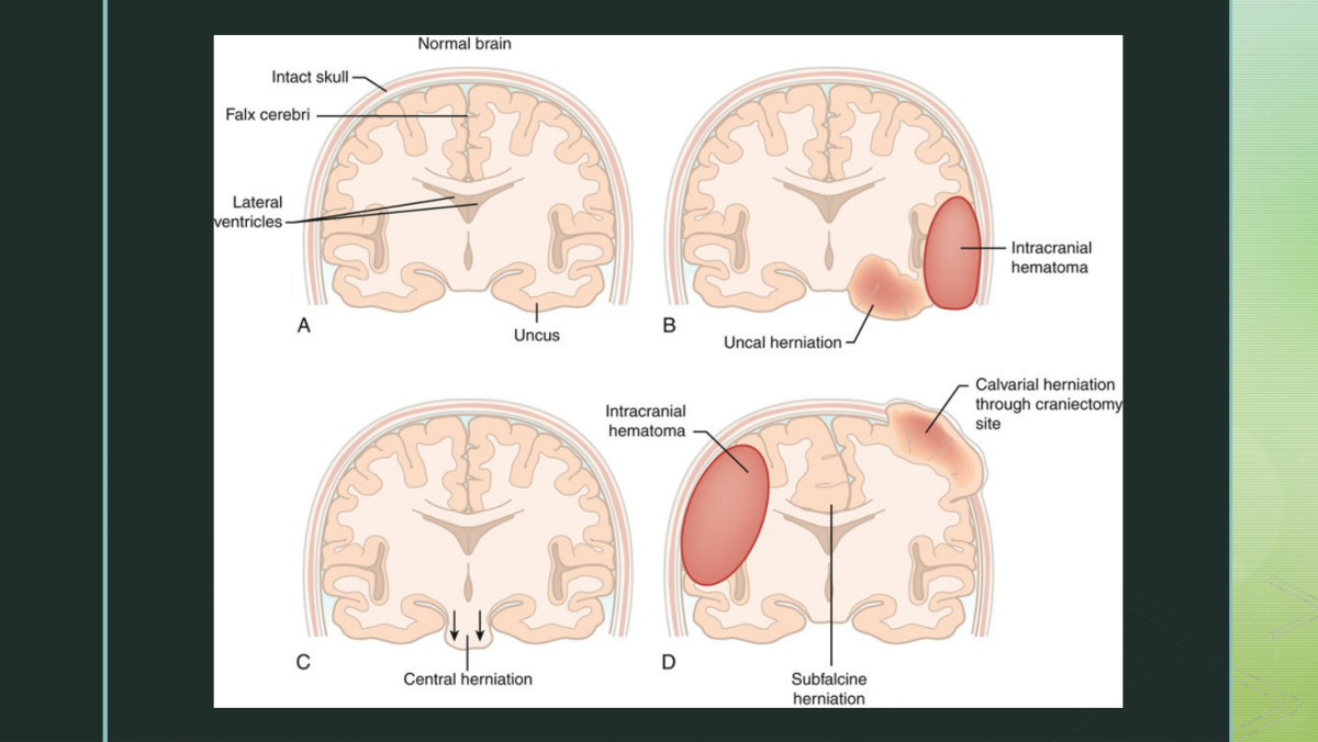 Her illustration of the herniation syndromes. She framed the slide this way: "these herniation descriptions are just showing where the herniation is occurring - so central, uncal and subfalcine." Match each arrow to the pupil finding in the table above; the pupils are how you tell them apart without a scan.