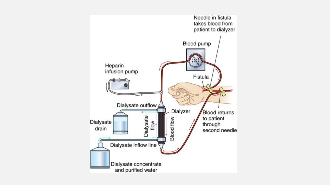The complete hemodialysis circuit she walked aloud. Trace it as a loop out of the patient and back; her own summary was that it is "going to clean out the blood and return it back to the patient." She also named the staffing the diagram implies - "there's going to be a large pump on the side that a dialysis nurse will be managing."