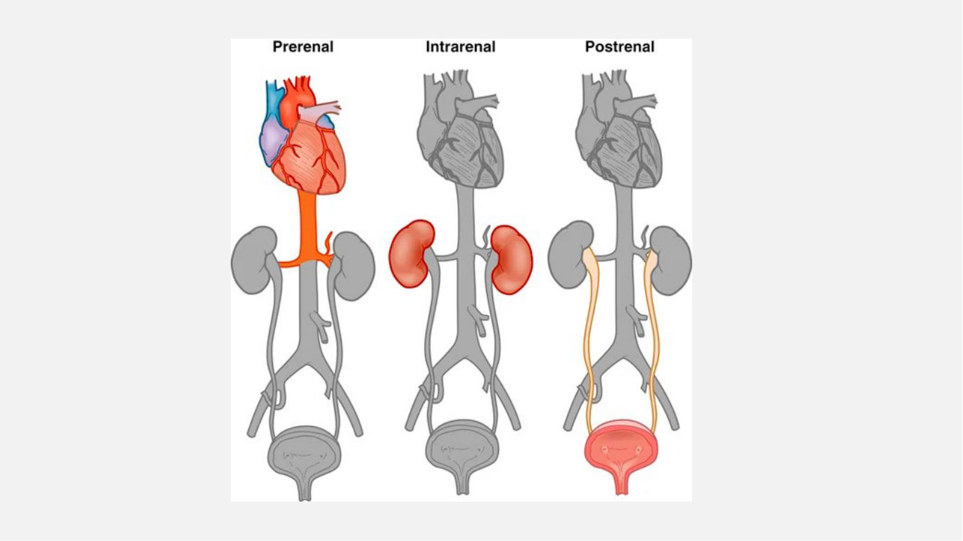 Her three-panel comparison of the cause categories. The coloured zone in each panel is where the problem sits - above the kidney, inside the kidney tissue, below the kidney. The middle panel is the only one in which the nephron itself is shaded, which is the whole difference between a kidney being starved or blocked and a kidney being damaged.